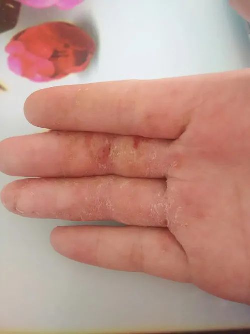 手部湿疹的发病原因有哪些?(有声科普)