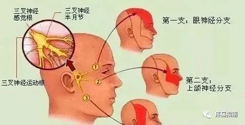 三叉神经痛属于中医"偏头痛","面痛"等范畴.