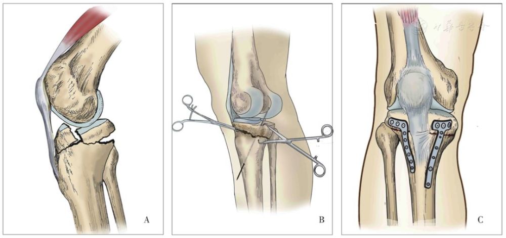 【骨科小技巧】过伸双髁胫骨平台骨折的复位与固定!