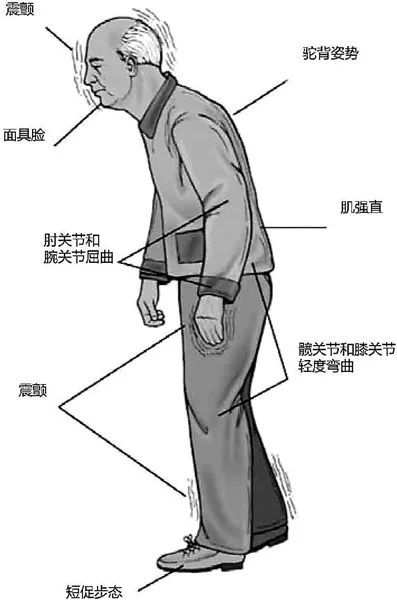 pd)是一种常见的中老年神经系统退行性疾病,以静止性震颤,四肢肌肉