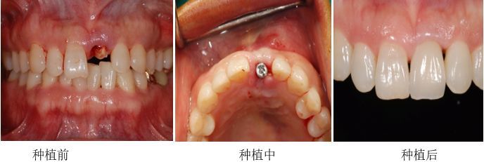 牙齿掉了怎么办?