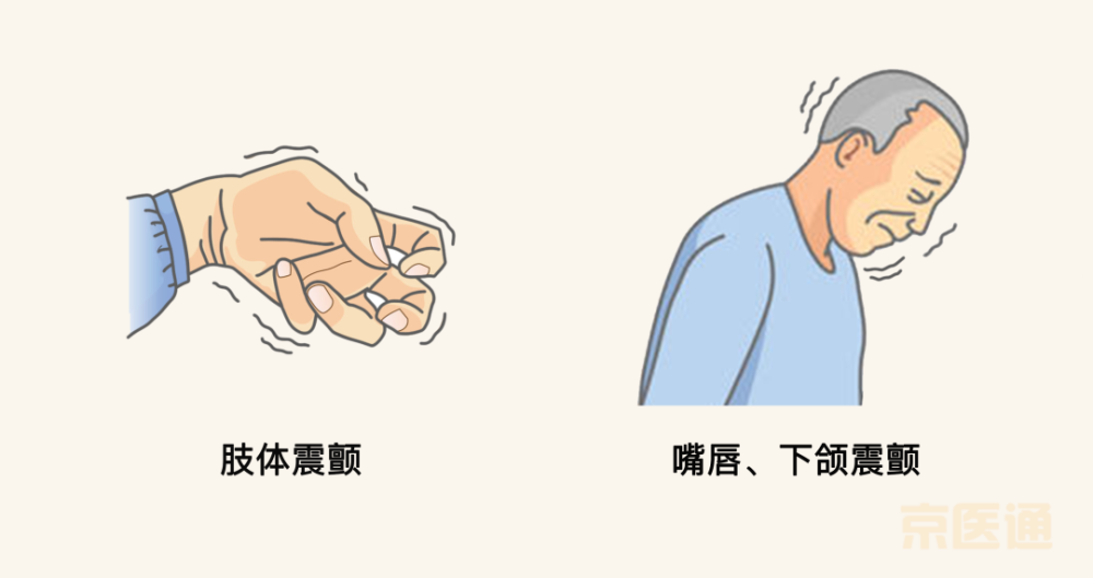 性震颤有所区别: 帕金森病患者抖动震颤的特征: 震颤常常是静止性震颤