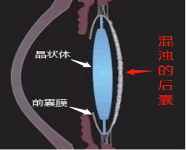 yag激光一击即中,后发障无影无踪