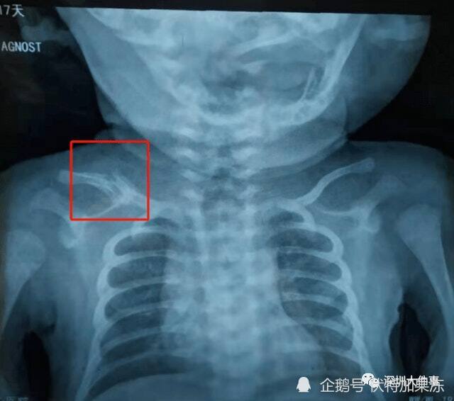 x光片显示,李先生儿子的右边锁骨骨折较为严重.