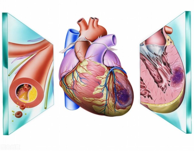 心肌梗死后心室重构导致心脏衰竭,如何防治?三种方法可供选择