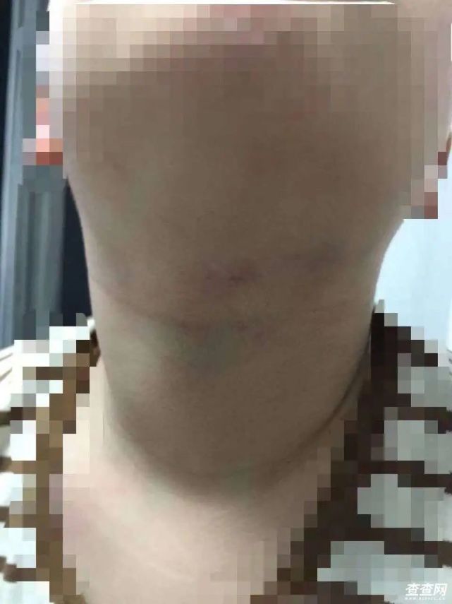 来自淮南家长的愤怒,孩子被辅导老师掐脖子导致淤青,谁来管?