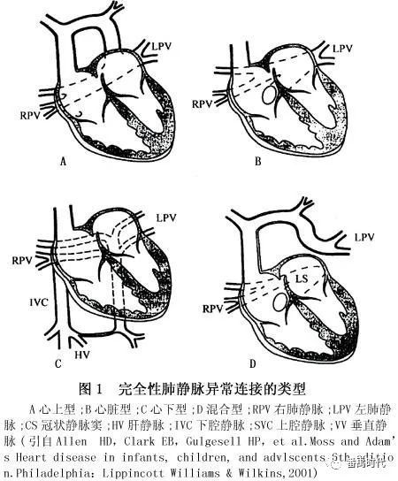 肺静脉异位回流概述