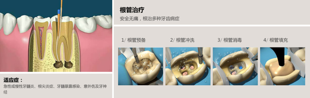 哪些牙齿问题需要做根管治疗?