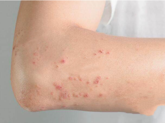 【长春肤康皮肤】湿疹前期症状图片