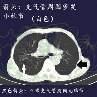 右肺中叶纤维条索影_肺部中叶索条影和微小结节_肺纤维条影可以自愈