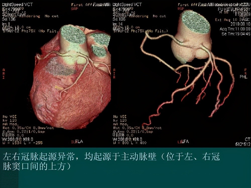 冠状动脉异常起源主动脉的并发症有心肌缺血,以及心肌