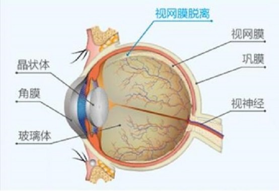 视网膜脱落能治好吗?具体有哪些症状?并发症有哪些?