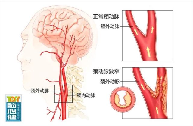 颈动脉狭窄对人类造成较大死亡威胁