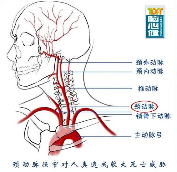 颈动脉狭窄对人类造成较大死亡威胁