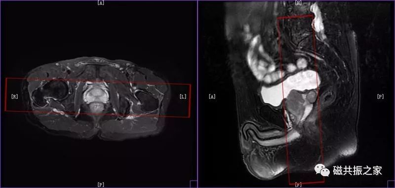 扫盲:前列腺mri该如何扫描!