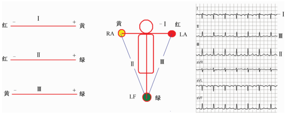 心电图有问题?别急,先看看导联位置放对了吗