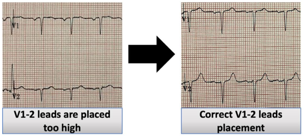 v1-2导联位置过高,导致假性前间壁陈旧性心梗