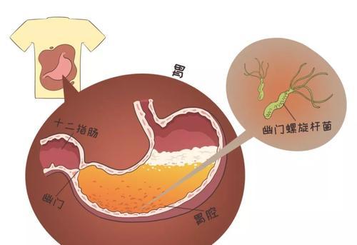 感染了幽门螺杆菌怎么办?