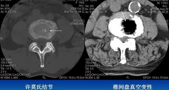 多发许莫氏结节 椎间盘真空