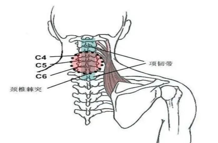 颈椎棘突应激点多见于棘上韧带,亦称项韧带,显性应激点常见于颈椎3,4