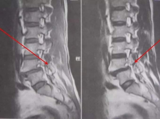 腰椎滑脱的影像及临床表现