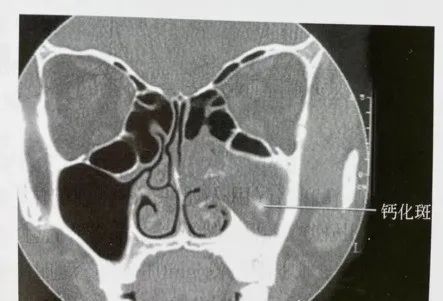 西安中大耳鼻喉医院解说鼻窦真菌病的鼻内镜手术治疗3分钟掌握