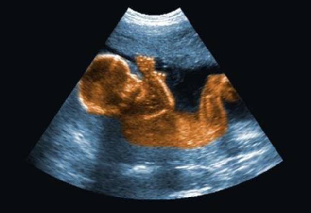 怀孕期间,做四维彩超时,为什么胎儿经常会捂着脸?