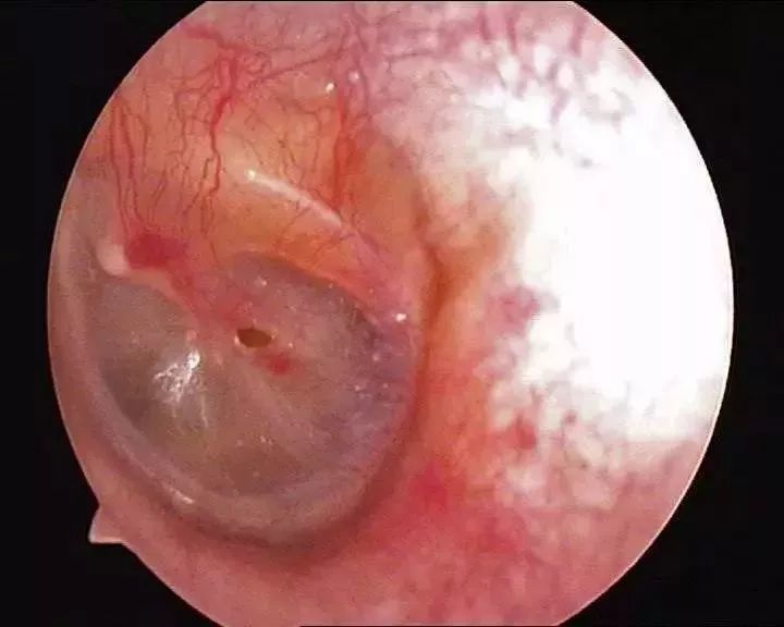 耳膜穿孔会导致耳聋吗,需要做手术吗?