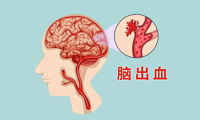 为什么脑梗,脑出血越来越年轻化?30几岁就脑出血,实属不应该