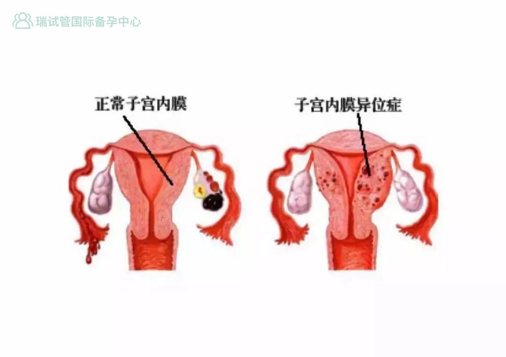 患子宫内膜异位症的女性,引发宫外孕的几率大,这是因为当孕卵与异位