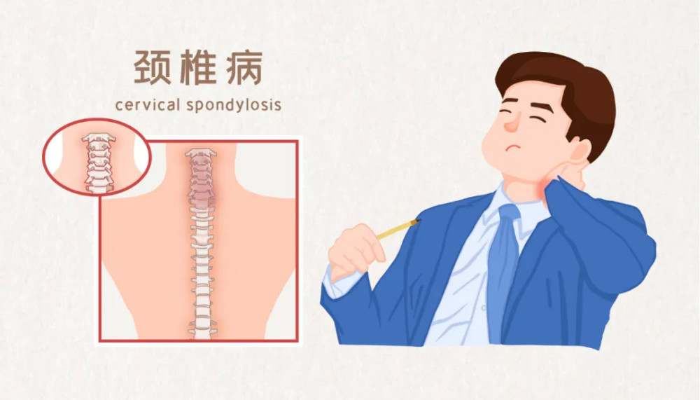 人未老颈已衰拿什么拯救你我未老先衰的颈椎