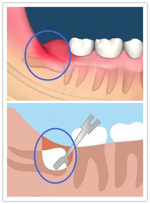 因为智齿在生长的过程中,通常会对周围的牙齿,牙龈组织造成压迫,产生