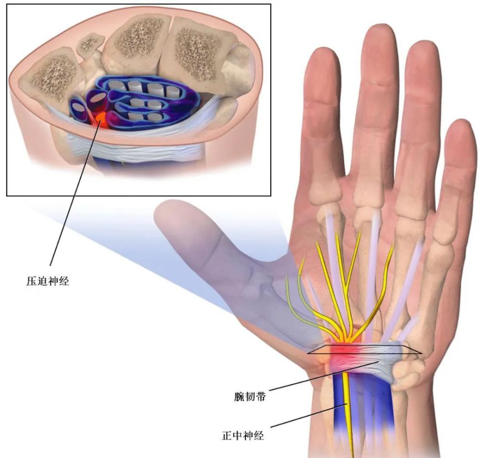 手和腕长期过度使用引起慢性损伤,腕横韧带及内容肌腱均可发生慢性