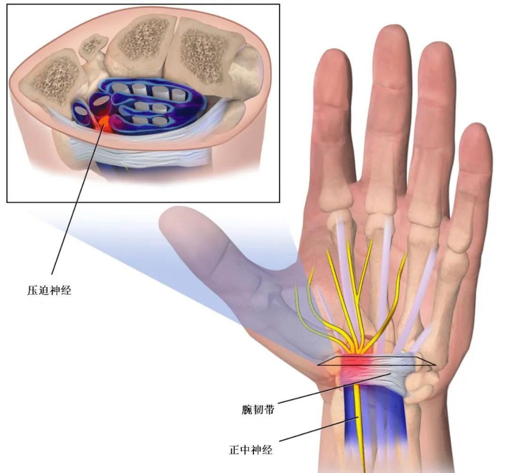 其次是腕部急性损伤,桡骨远端骨折,月骨脱位可引起正中神经急性或
