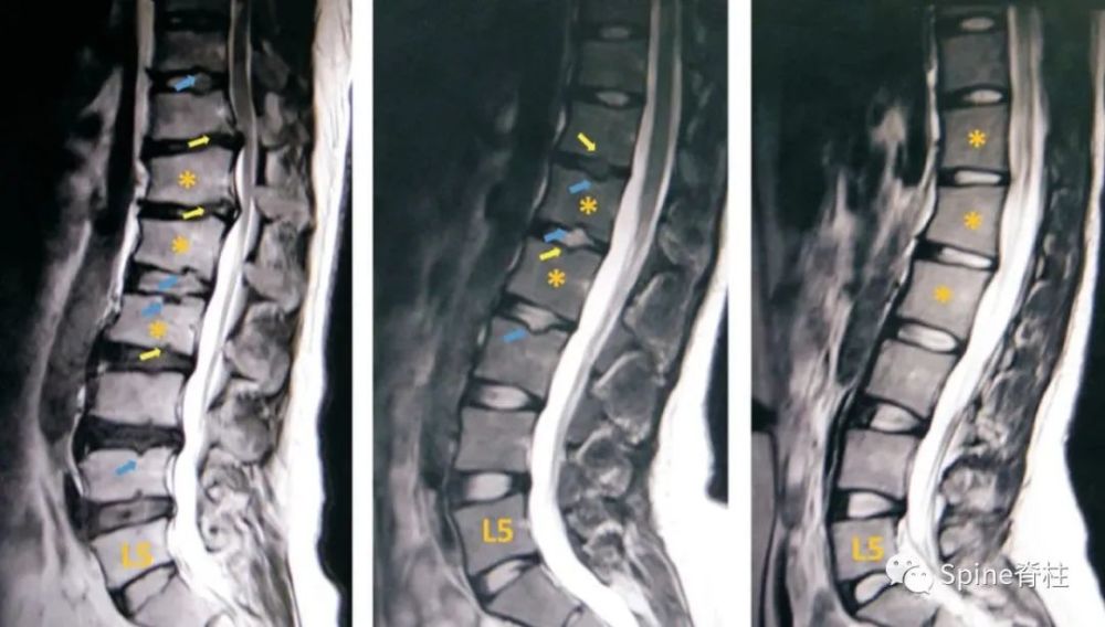 中间为腰型休门氏病(t12和l2椎体楔形变,黄箭头许莫氏结节,橘 左图