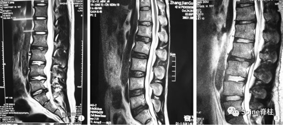 中间为腰型休门氏病(t12和l2椎体楔形变,黄箭头许莫氏结节,橘 图1