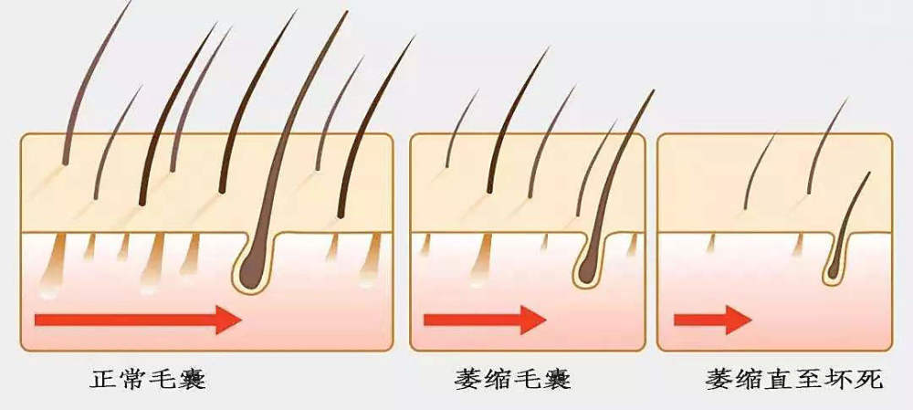 脱发的发根处有硬块,是不是代表毛囊坏死了?