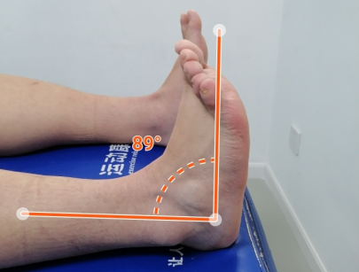 正常足背屈的角度要达到20-25°才算正常,他的足背屈角度明显不足