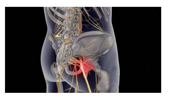 坐骨神经痛药圣井最佳的治疗方法