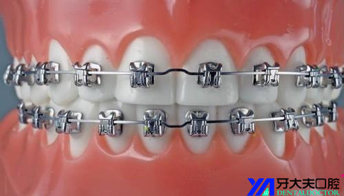 如何选择正确的牙齿矫正器?