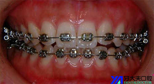 矫正的重点项目—牙齿矫正,大家的第一反应就是笑起来满嘴的金属钢丝