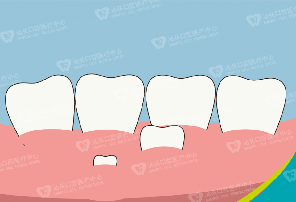 多生牙是什么原因导致的?一定要拔除吗?