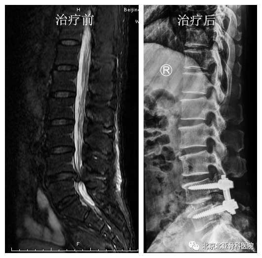 北亚脊柱科手术治疗巨大腰间盘突出严重活动受限患者1