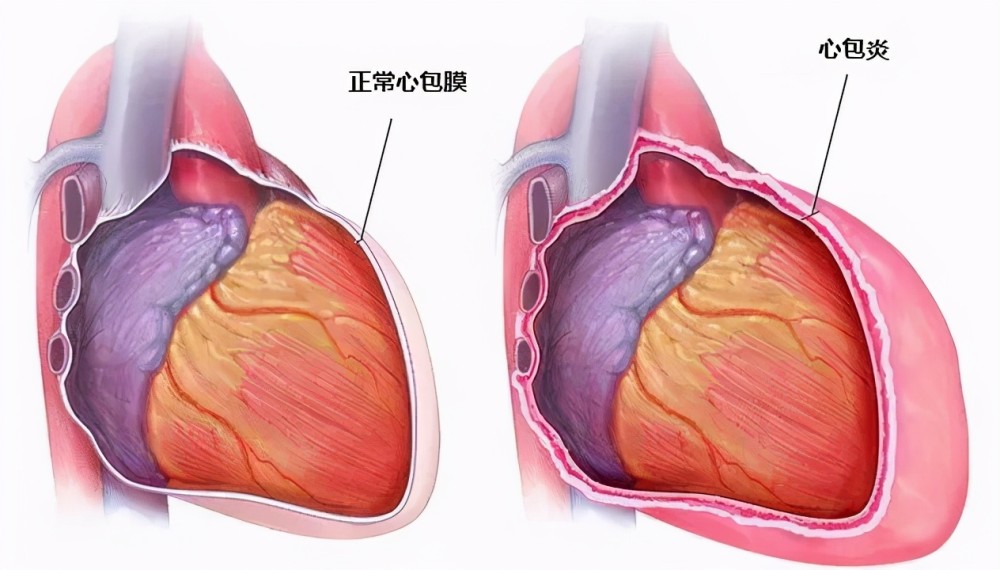 十一,急性心包炎