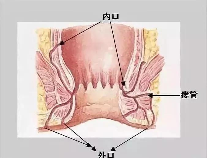肛瘘——比痔疮危害更大,屁屁有这5个异常,你可能已经