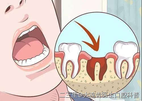 【注意】你知道拔牙后留下的牙洞会怎么样吗?