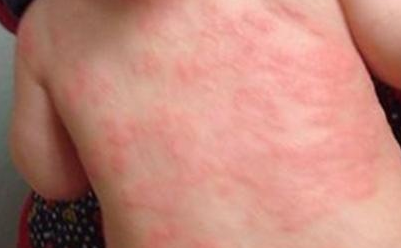 "皮肤瘙痒"还起红疙瘩?究竟是"湿疹还是荨麻疹"?