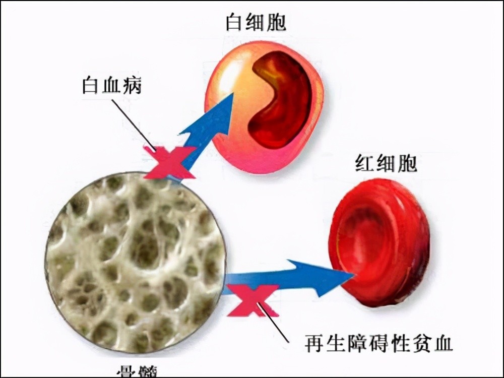 【史淑荣工作室】正确认识:再生障碍性贫血与白血病有什么区别