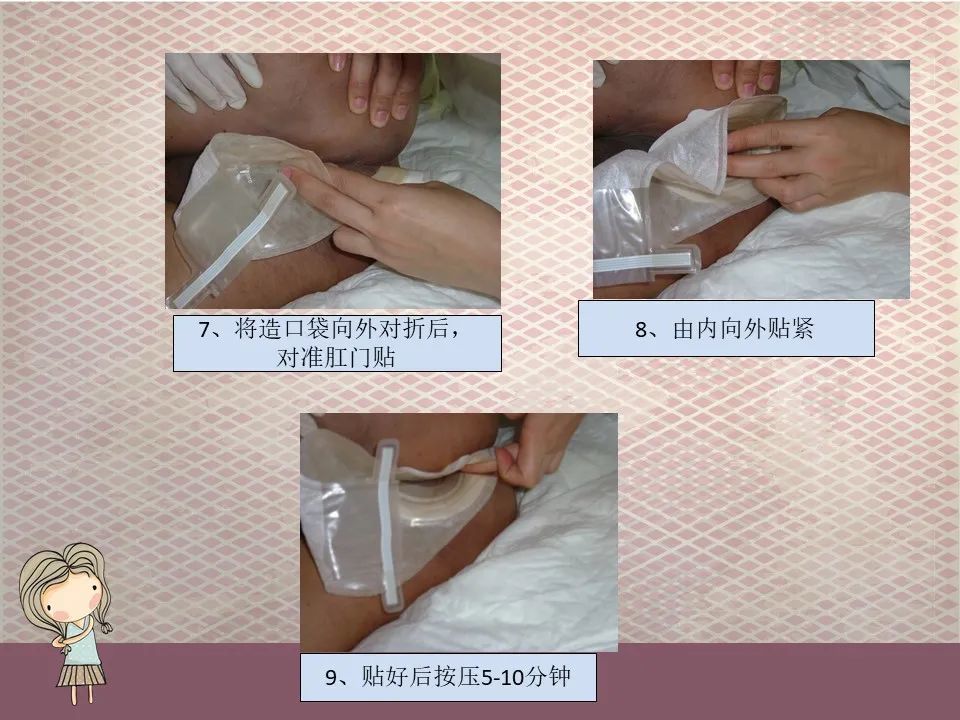 ppt:造口袋持续负压吸引引流稀便