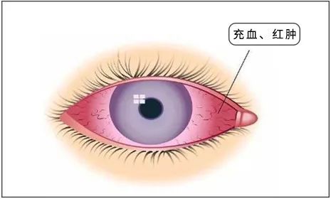 一到春天眼睛奇痒无比?当心过敏性结膜炎!